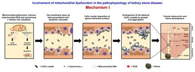 Mitochondrial Dysfunction and Kidney Stone Disease